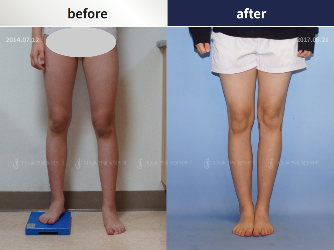 Before and after paediatric & adolescent lld, case 4320411, image 3, Dr. Donghoon institute (DALRI)