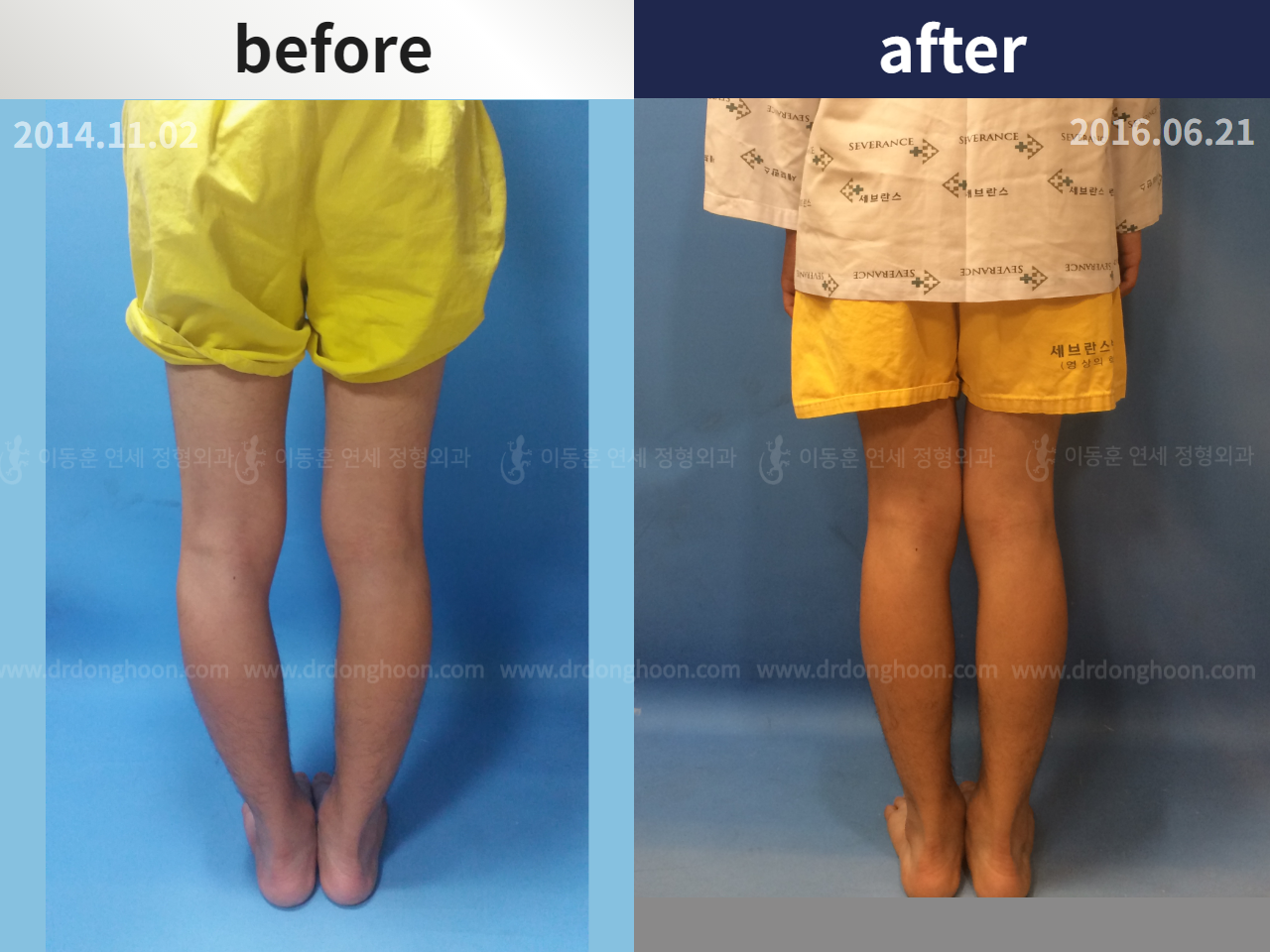 Before and after paediatric & adolescent bowlegs, case 4320233, image 2, Dr. Donghoon institute (DALRI)