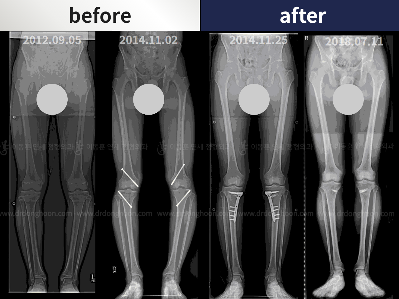 Before and after paediatric & adolescent bowlegs, case 4320233, image 3, Dr. Donghoon institute (DALRI)