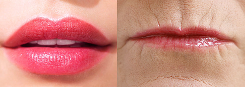나이든 입술의 특징, 60대 입술필러 후 : 청담아리움의원