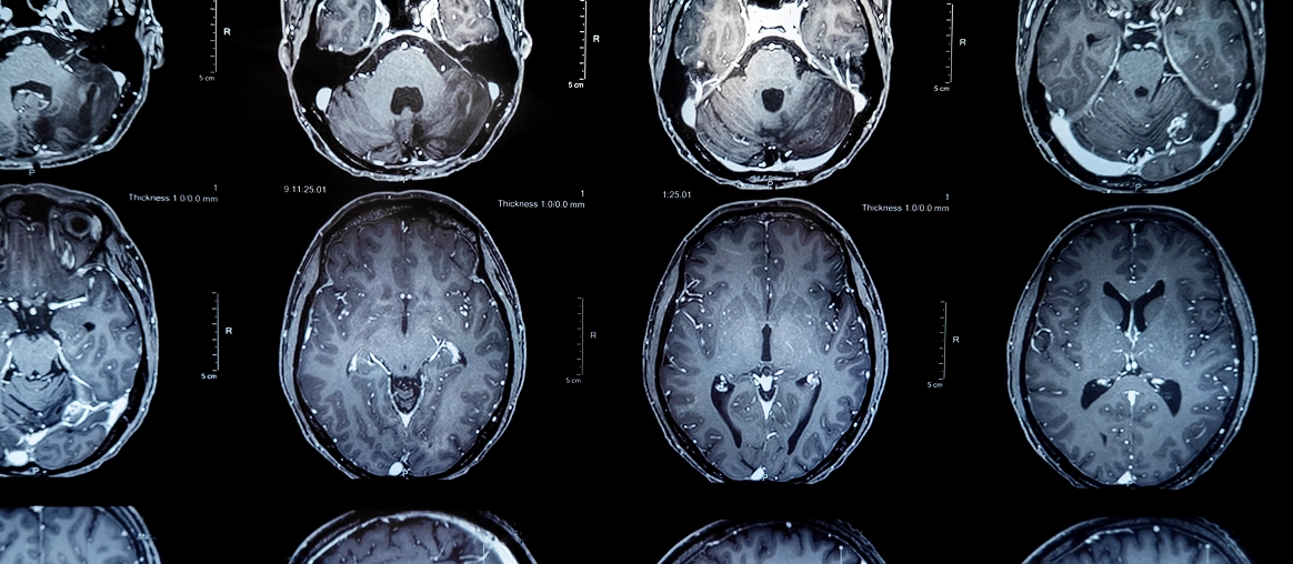 뇌 MRI 축상면(axial) 연속 촬영 영상을 격자로 배열한 이미지로, 의료 AI 영상 분석을 다루는 바로AI(BARO AI) 테크 블로그의 참고 시각 자료입니다.