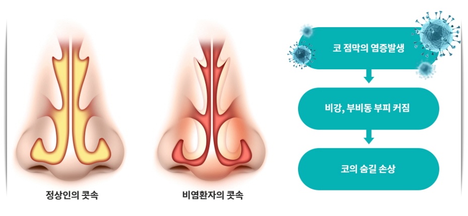 비염 축농증 차이 설명 이미지