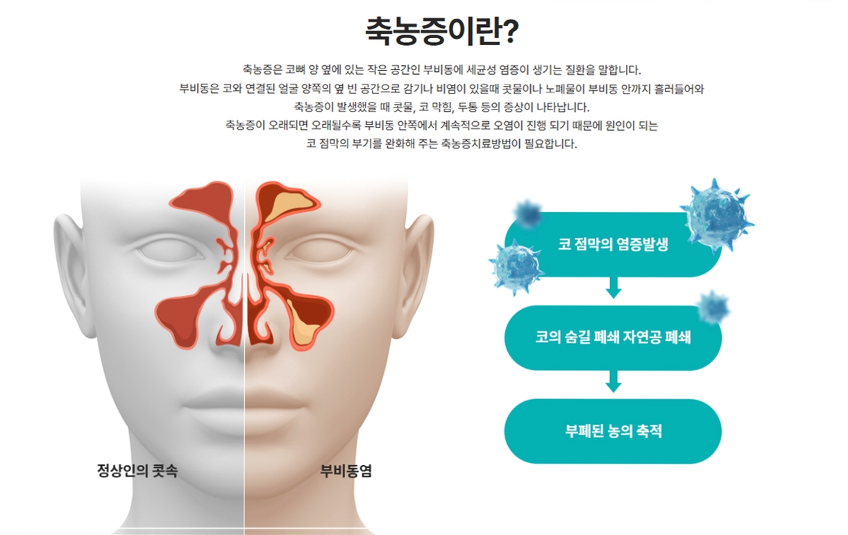 축농증의 발생 원리