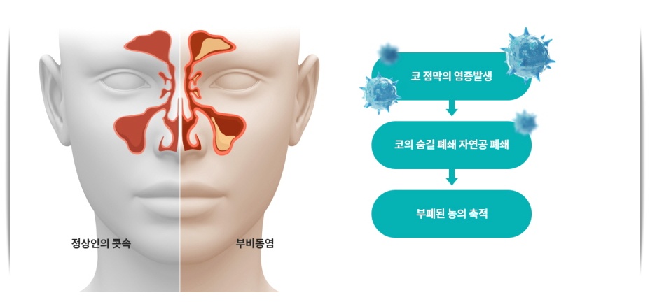 축농증(부비동염) 설명 이미지