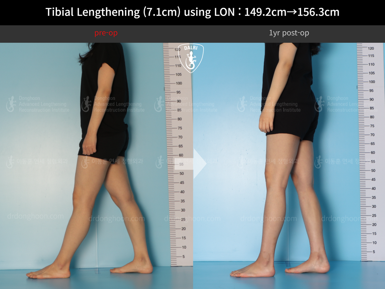 Before and after cll lon, case 14264800, image 4, Dr. Donghoon institute (DALRI)