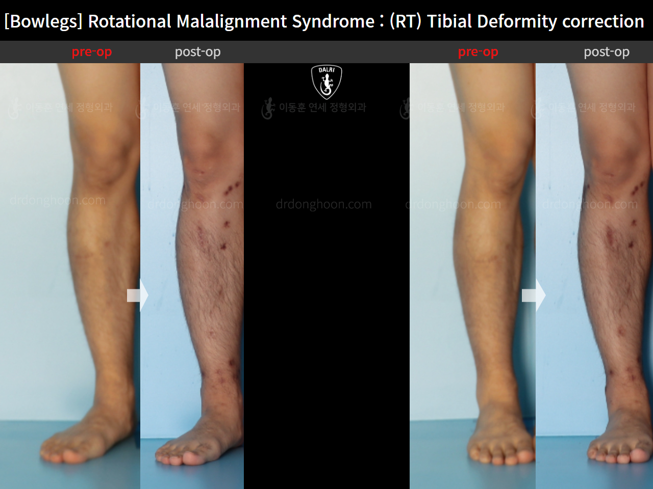 Before and after adult bowlegs, case 16482195, image 7, Dr. Donghoon institute (DALRI)