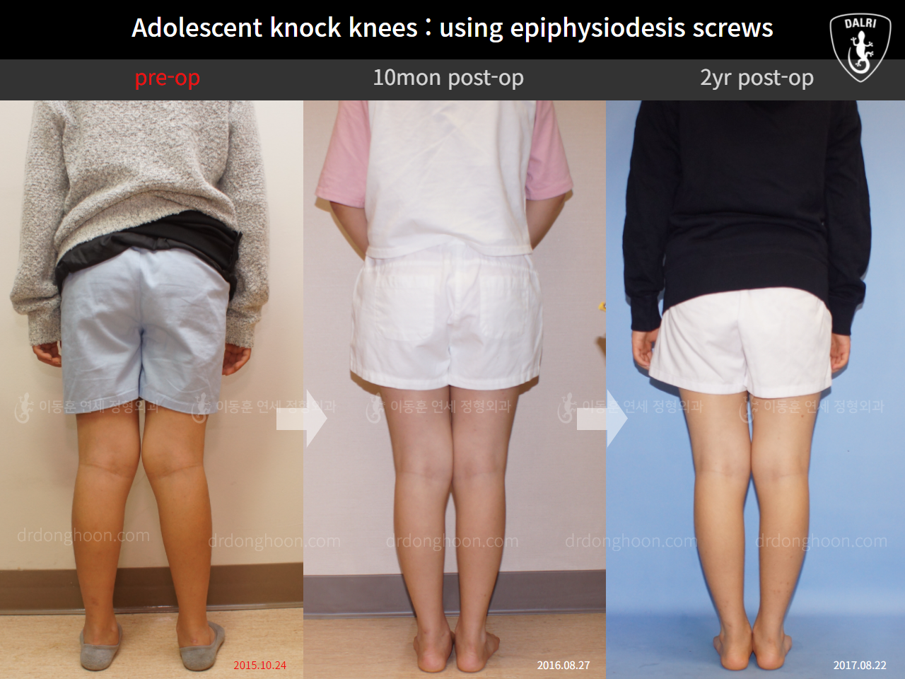 Before and after paediatric & adolescent knock knees, case 4640518, image 2, Dr. Donghoon institute (DALRI)