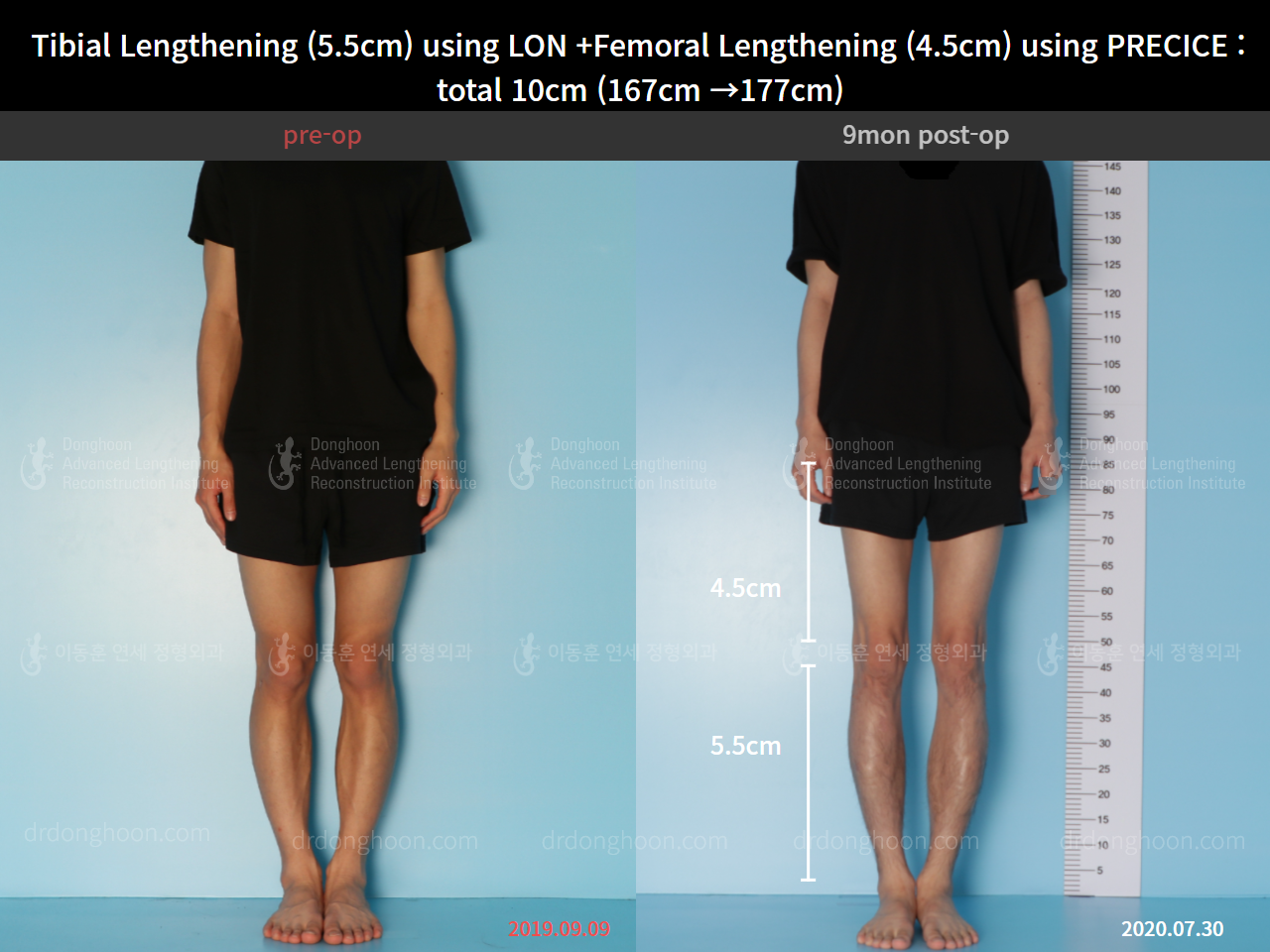 Before and after cll precice, case 4662233, image 1, Dr. Donghoon institute (DALRI)