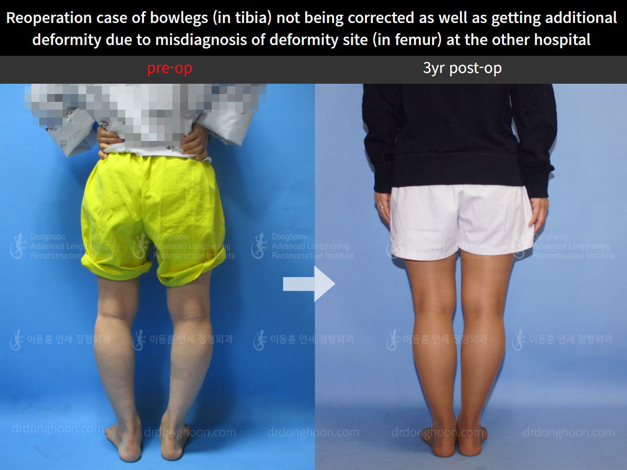 Before and after reoperation after deformity correction, case 5306623, image 3, Dr. Donghoon institute (DALRI)