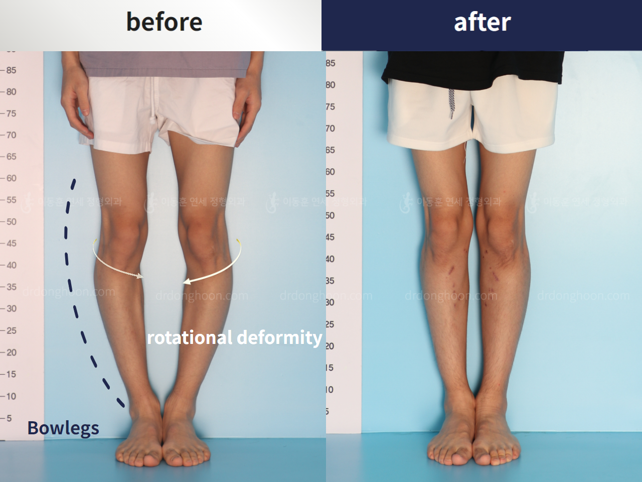 Before and after complex deformity, case 4297349, image 1, Dr. Donghoon institute (DALRI)