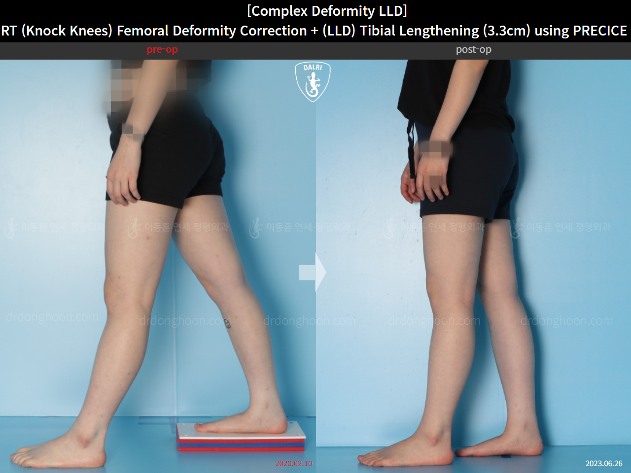 Before and after complex deformity, case 15584182, image 7, Dr. Donghoon institute (DALRI)