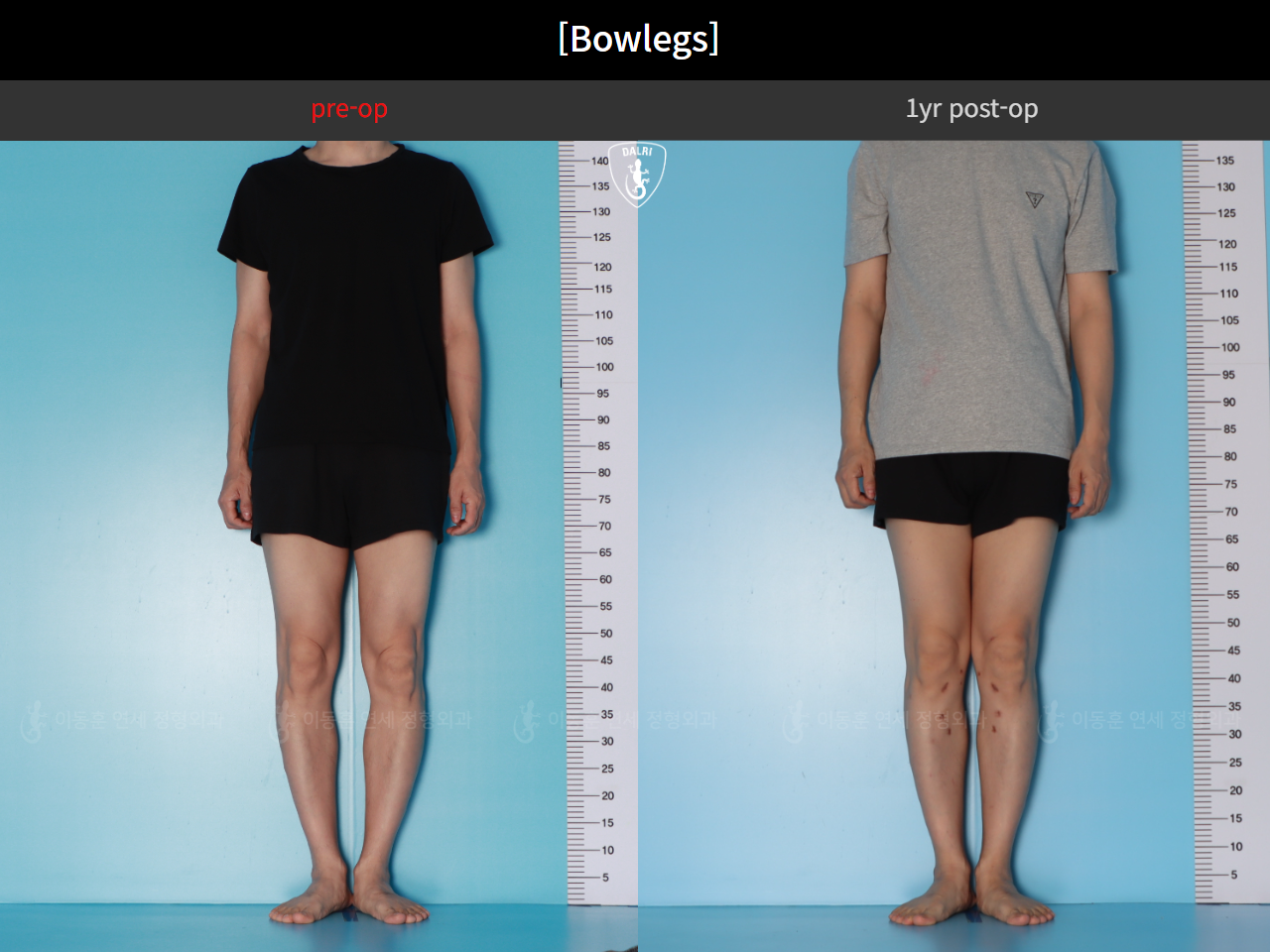 Before and after adult bowlegs, case 125438866, image 6, Dr. Donghoon institute (DALRI)