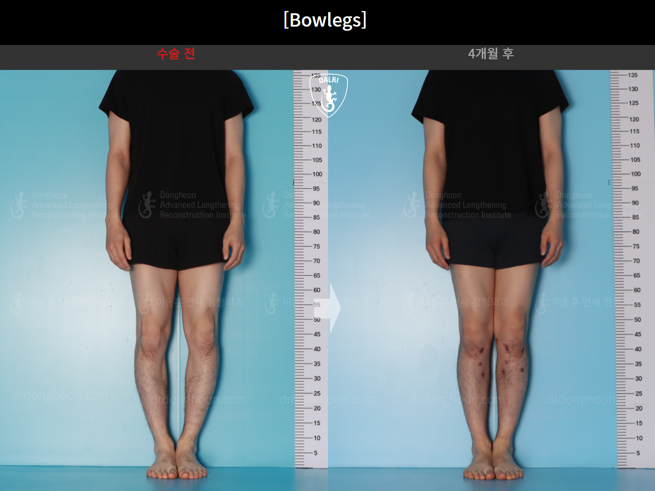 Before and after adult bowlegs, case 21098909, image 1, Dr. Donghoon institute (DALRI)