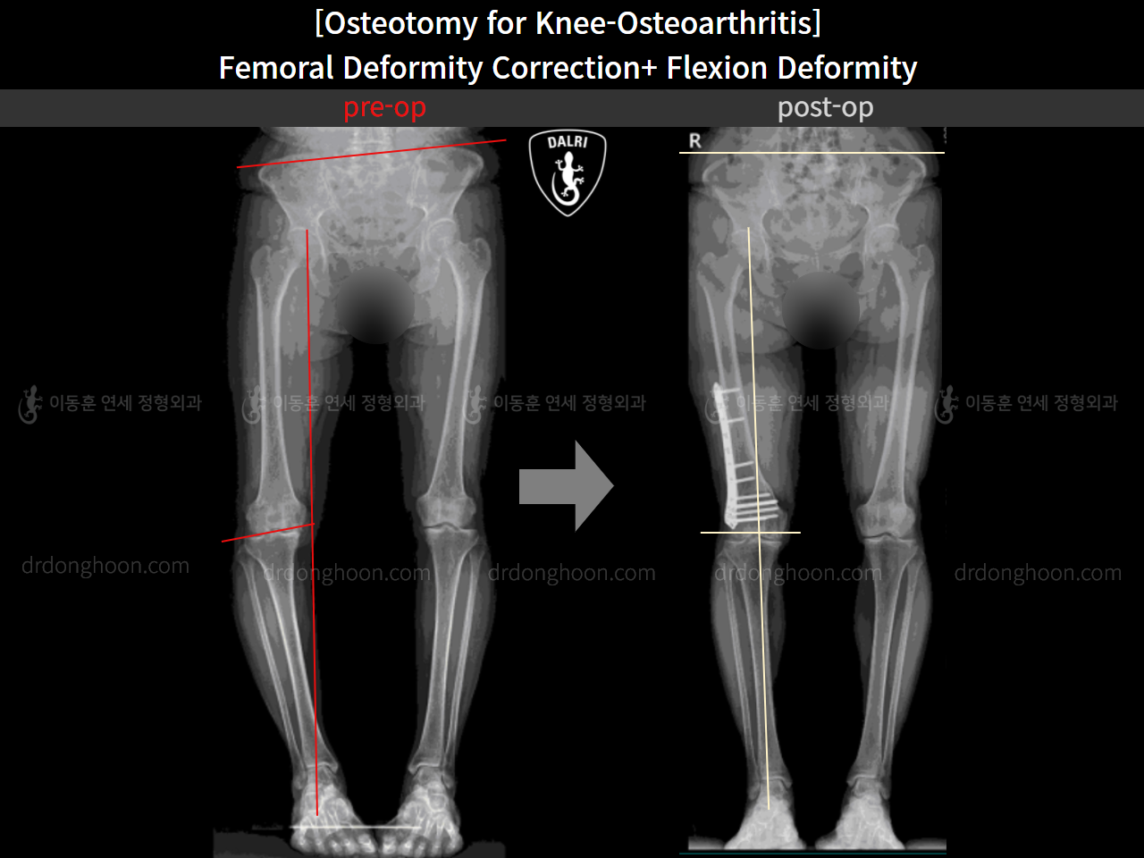 Before and after osteotomy for knee osteoarthritis, case 11380349, image 3, Dr. Donghoon institute (DALRI)