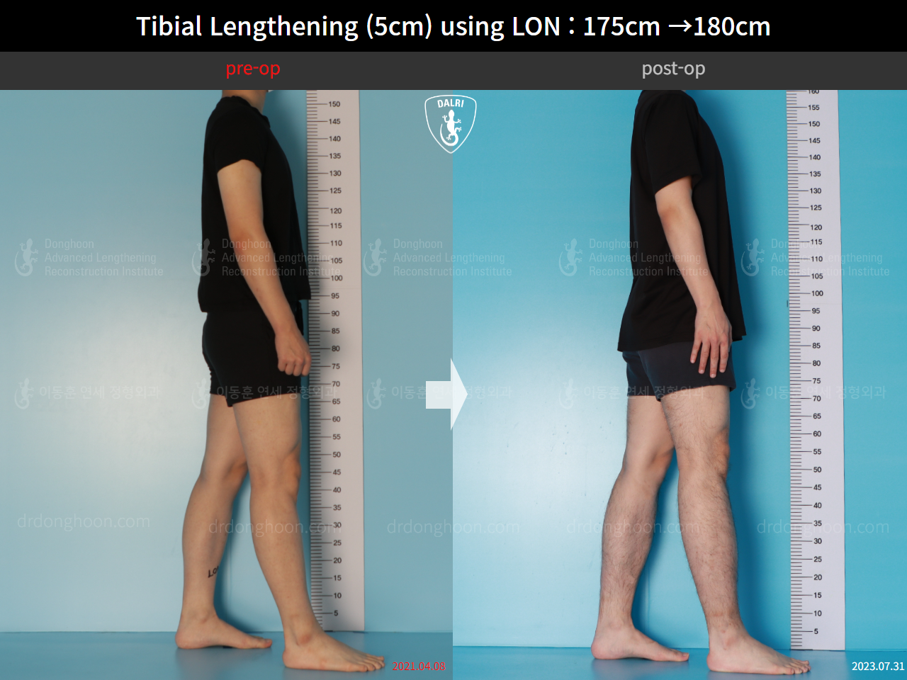 Before and after cll lon, case 15931051, image 3, Dr. Donghoon institute (DALRI)