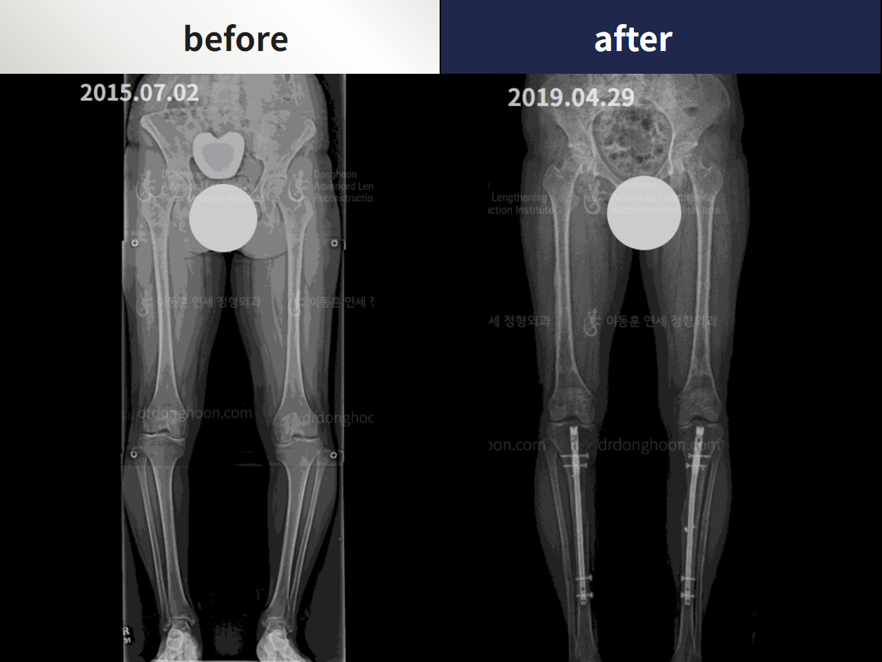 Before and after congenital condition, case 4304651, image 3, Dr. Donghoon institute (DALRI)