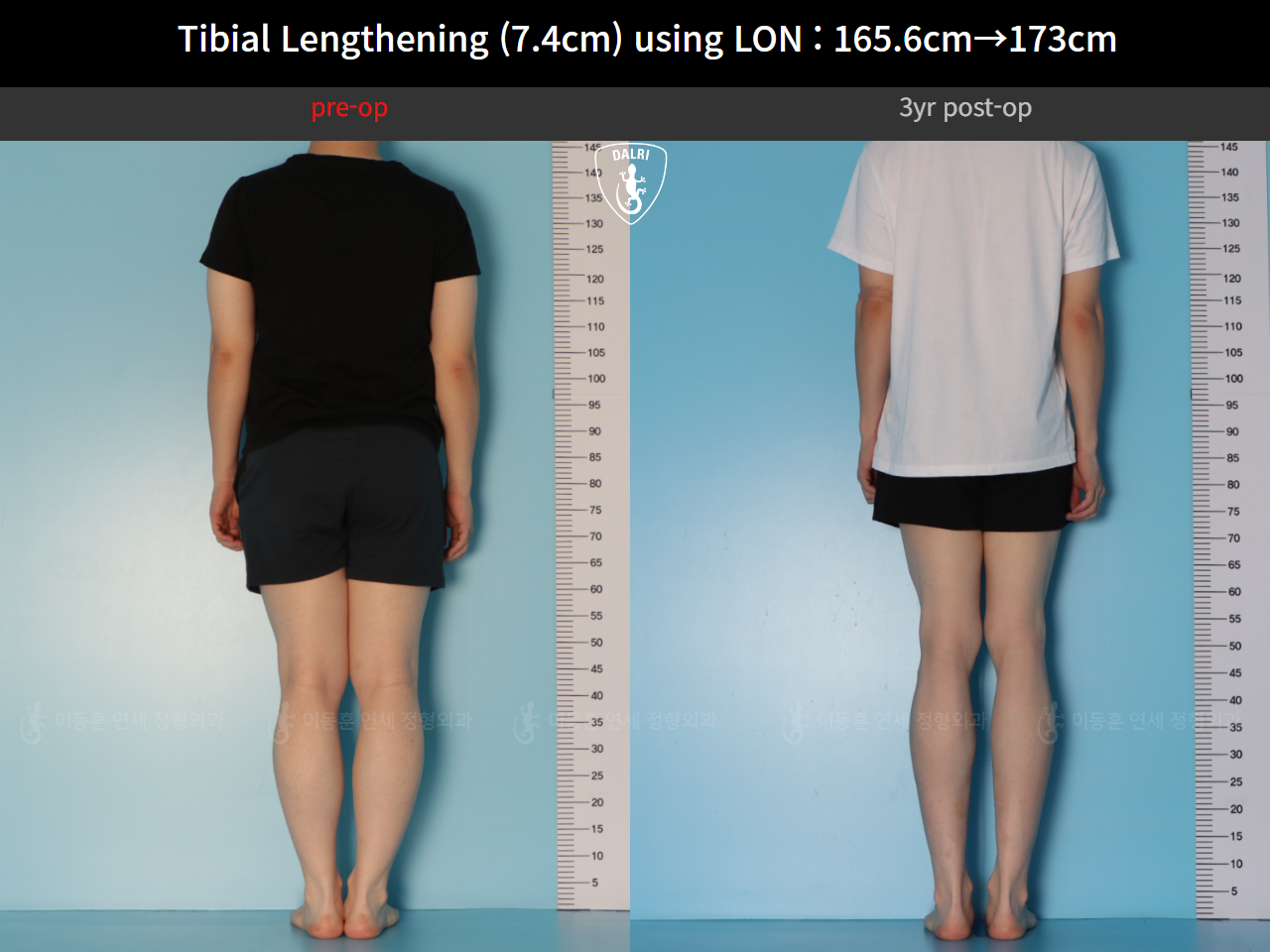 Before and after cll lon, case 125561518, image 4, Dr. Donghoon institute (DALRI)