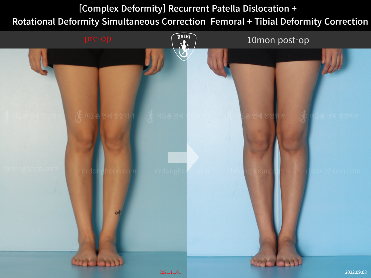 Before and after recurrent patella dislocation, case 12860886, image 5, Dr. Donghoon institute (DALRI)