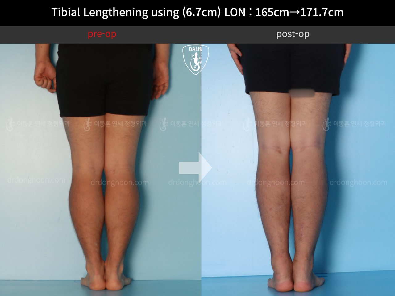 Before and after cll lon, case 12242883, image 4, Dr. Donghoon institute (DALRI)