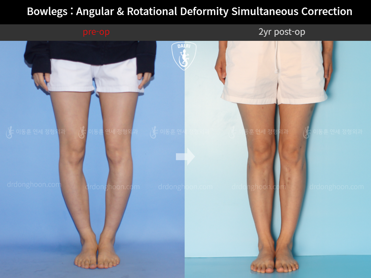 Before and after adult bowlegs, case 4311375, image 5, Dr. Donghoon institute (DALRI)