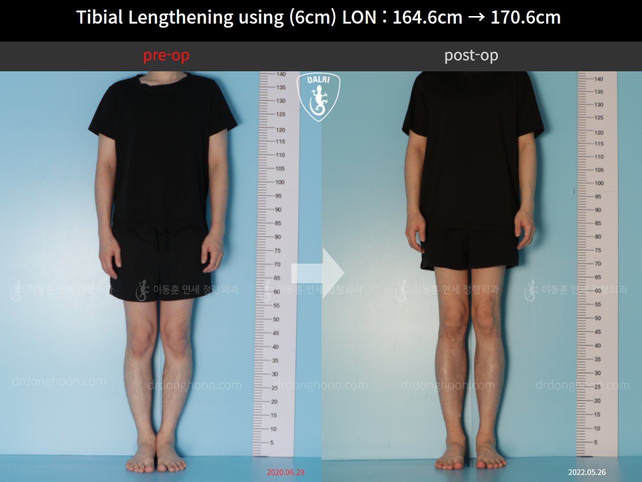 Before and after cll lon, case 11674504, image 1, Dr. Donghoon institute (DALRI)