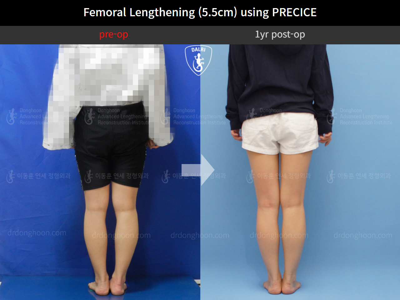 Before and after cll precice, case 4573623, image 4, Dr. Donghoon institute (DALRI)