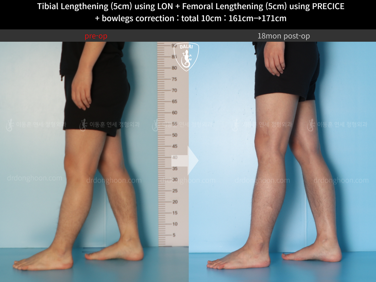 Before and after cll precice, case 13660867, image 9, Dr. Donghoon institute (DALRI)