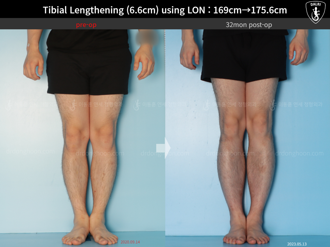 Before and after cll lon, case 15166302, image 9, Dr. Donghoon institute (DALRI)