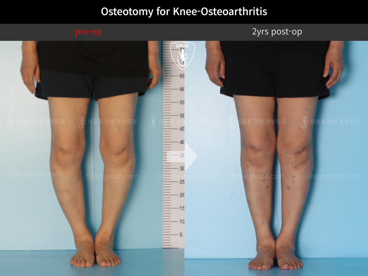 Before and after osteotomy for knee osteoarthritis, case 12844528, image 5, Dr. Donghoon institute (DALRI)