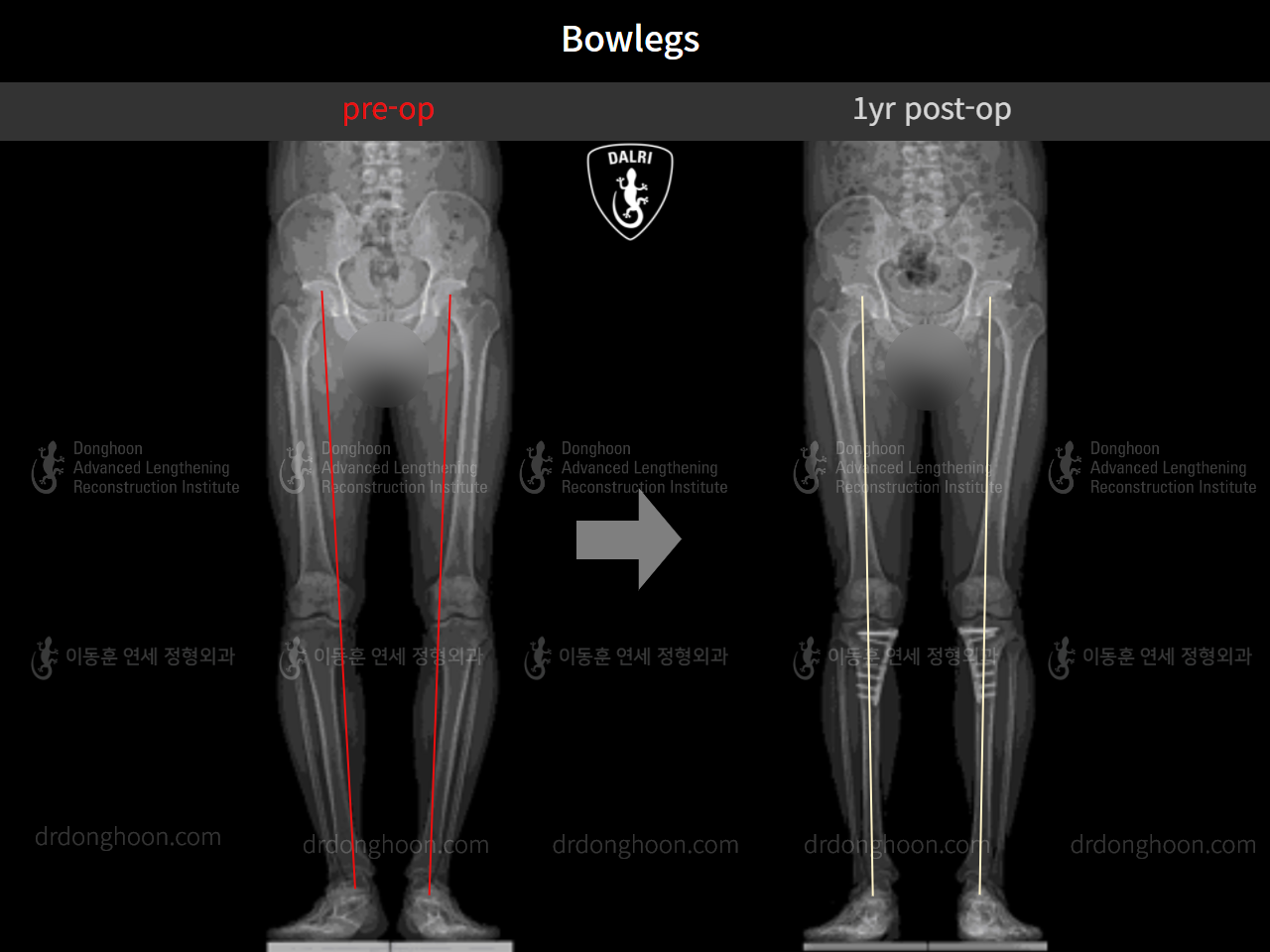 Before and after adult bowlegs, case 9487634, image 7, Dr. Donghoon institute (DALRI)