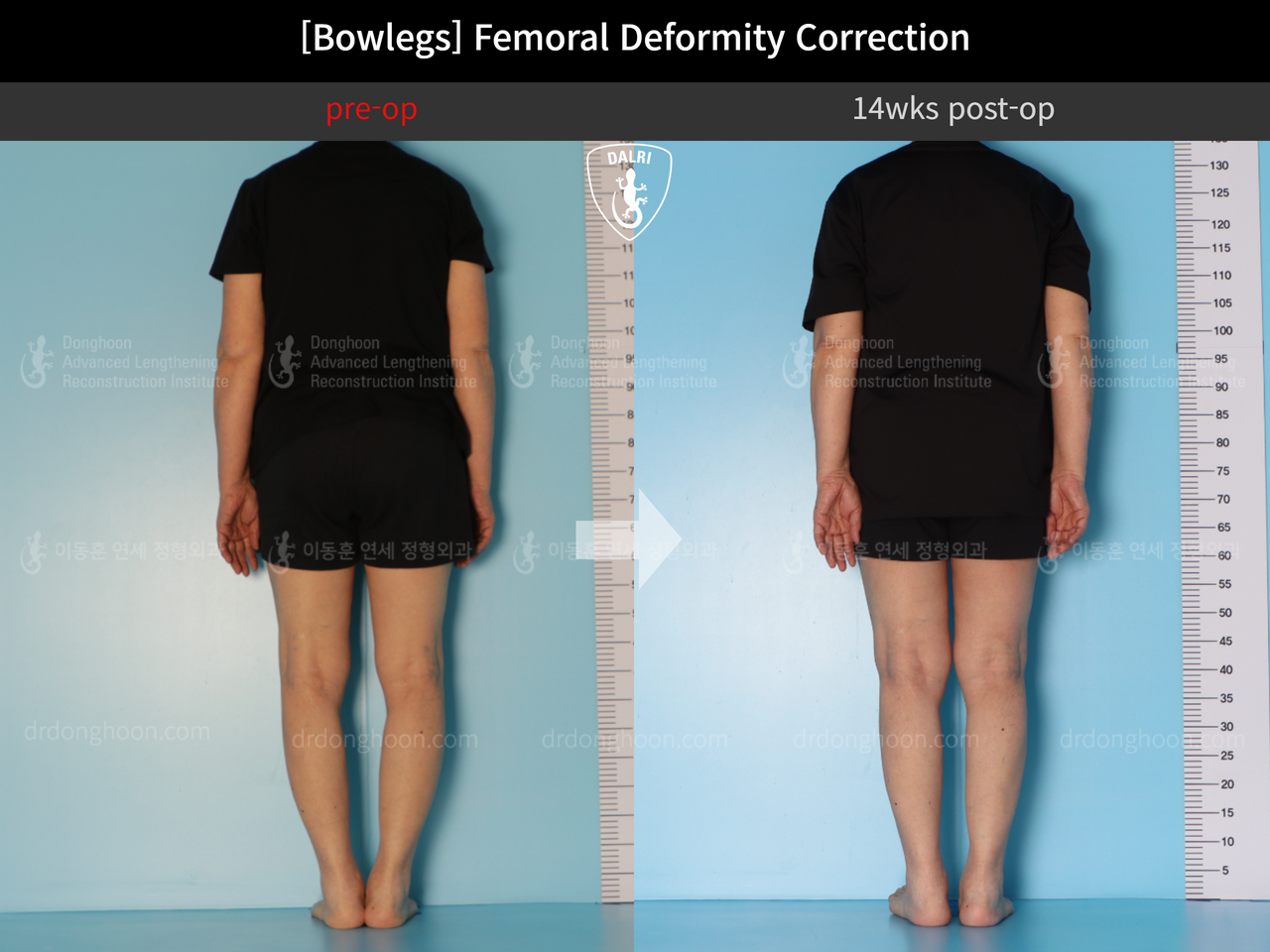 Before and after adult bowlegs, case 12791222, image 2, Dr. Donghoon institute (DALRI)