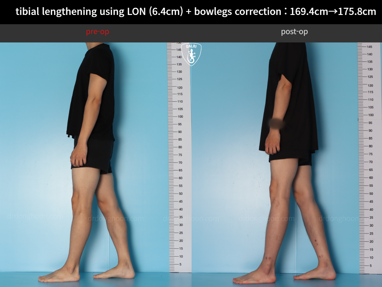 Before and after cll + deformity correction, case 36736776, image 5, Dr. Donghoon institute (DALRI)