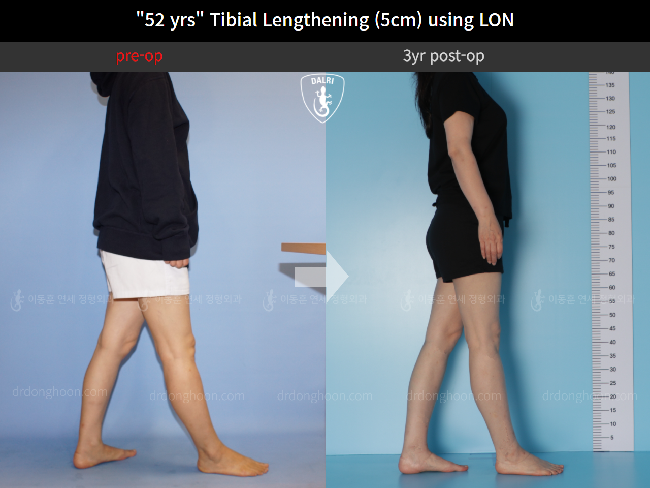Before and after cll lon, case 9977769, image 4, Dr. Donghoon institute (DALRI)
