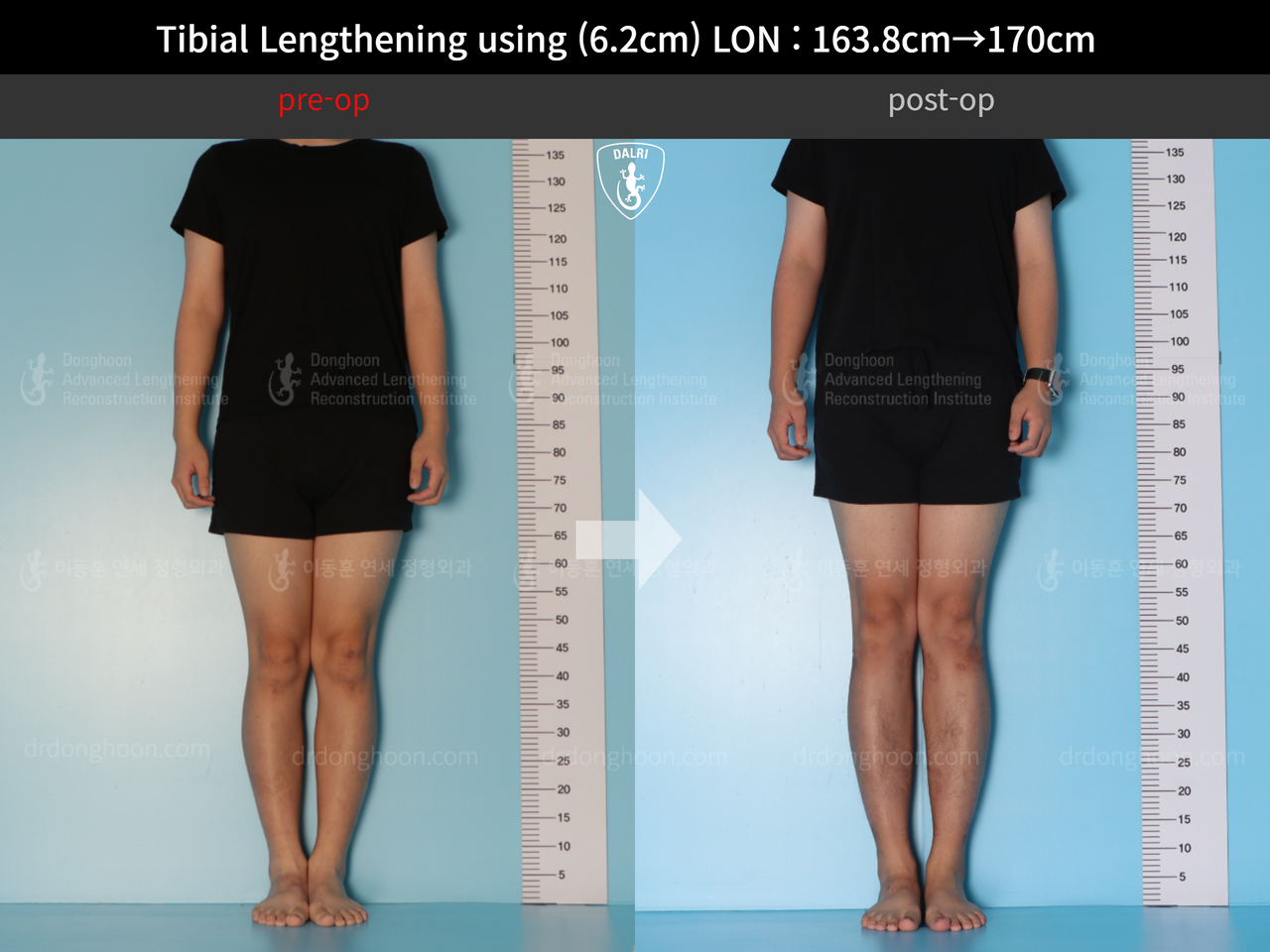 Before and after cll lon, case 13001983, image 1, Dr. Donghoon institute (DALRI)