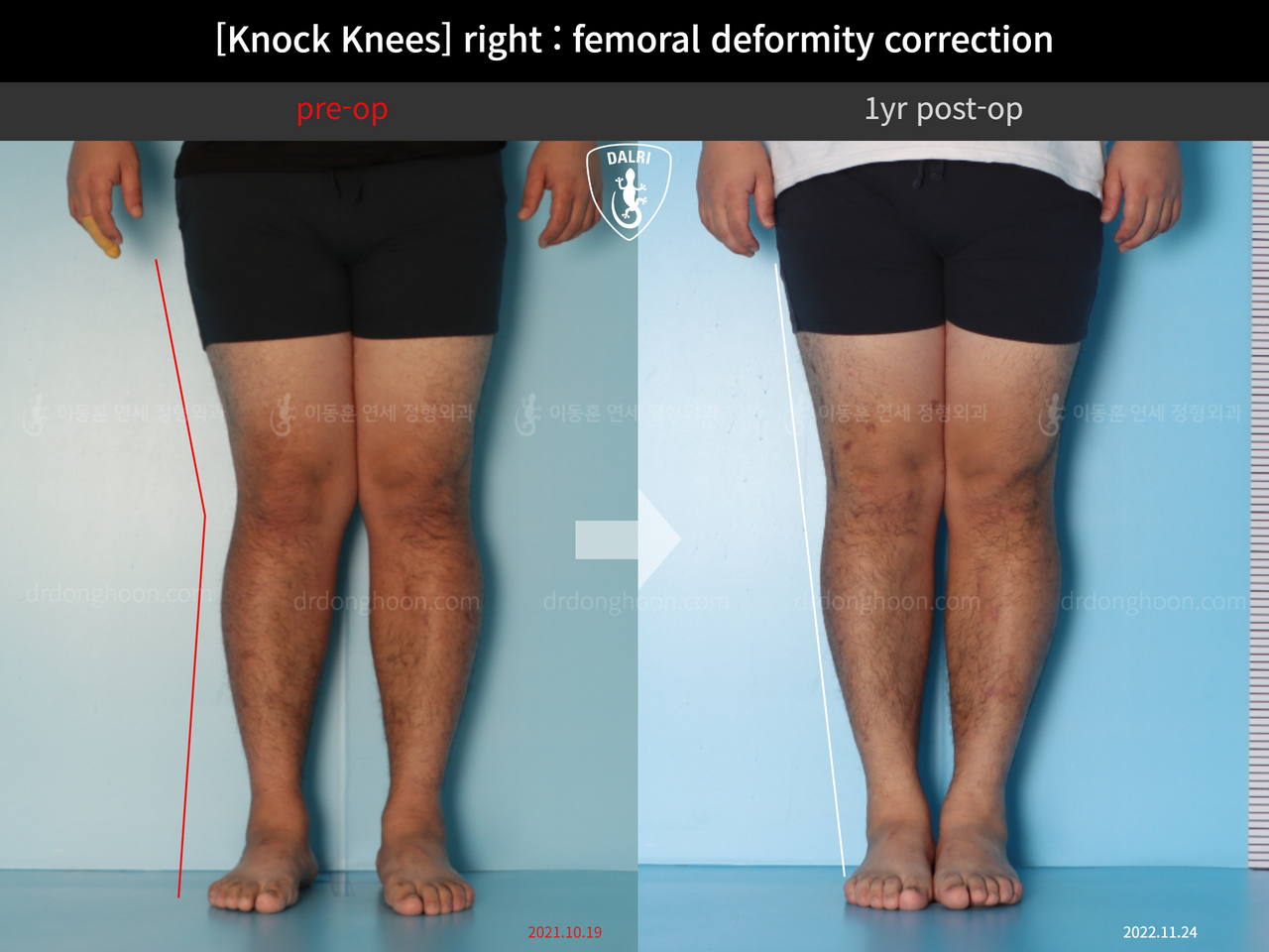 Before and after adult knock knees, case 13582115, image 3, Dr. Donghoon institute (DALRI)