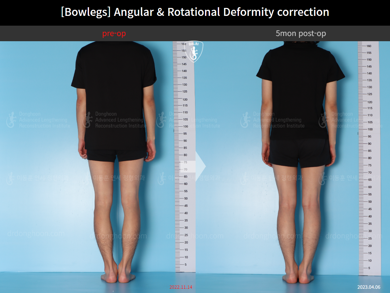 Before and after adult bowlegs, case 14707617, image 3, Dr. Donghoon institute (DALRI)