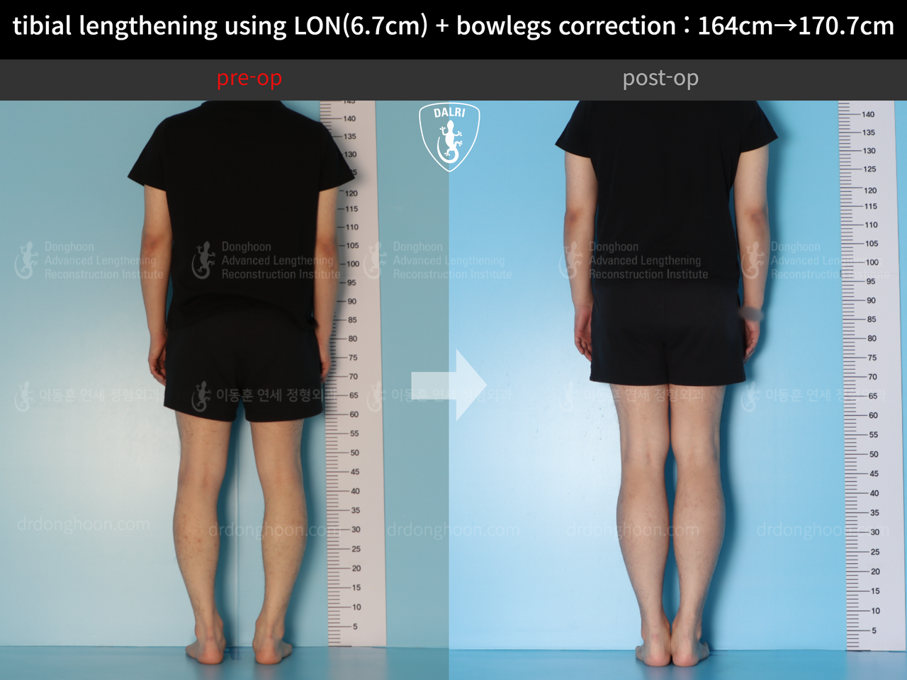 Before and after cll + deformity correction, case 13914972, image 3, Dr. Donghoon institute (DALRI)