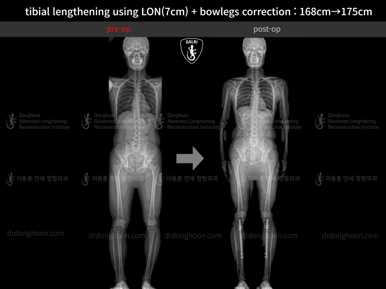 Tibial Lengthening Using LON(7cm) + Bowlegs Correction : 168cm→175cm ...