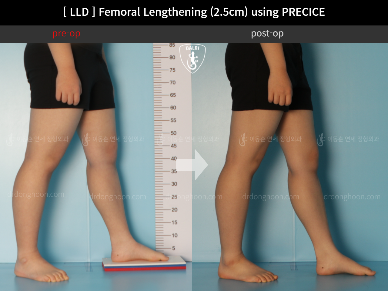 Before and after adult lld, case 11367647, image 8, Dr. Donghoon institute (DALRI)