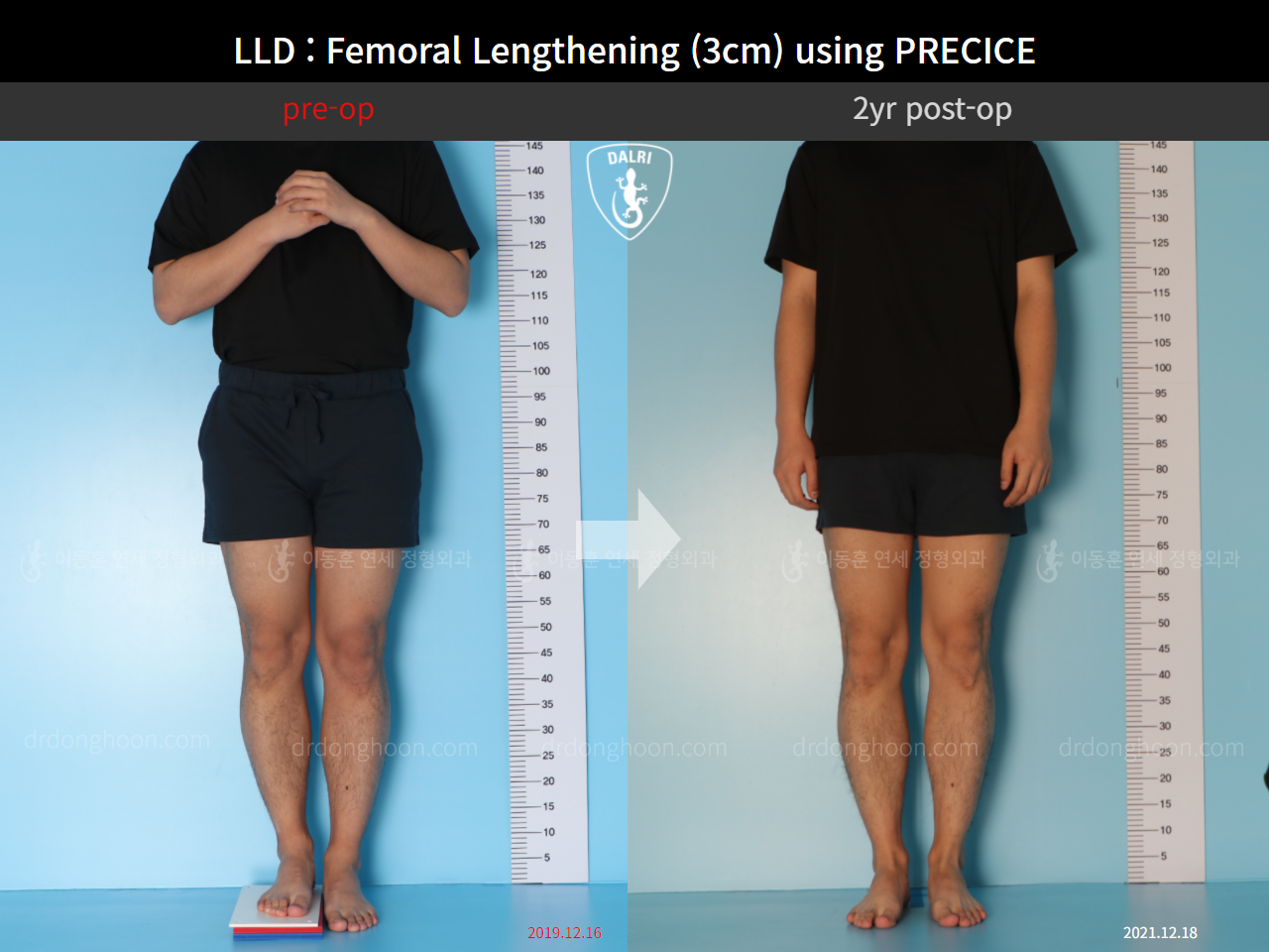 Before and after adult lld, case 10665047, image 1, Dr. Donghoon institute (DALRI)