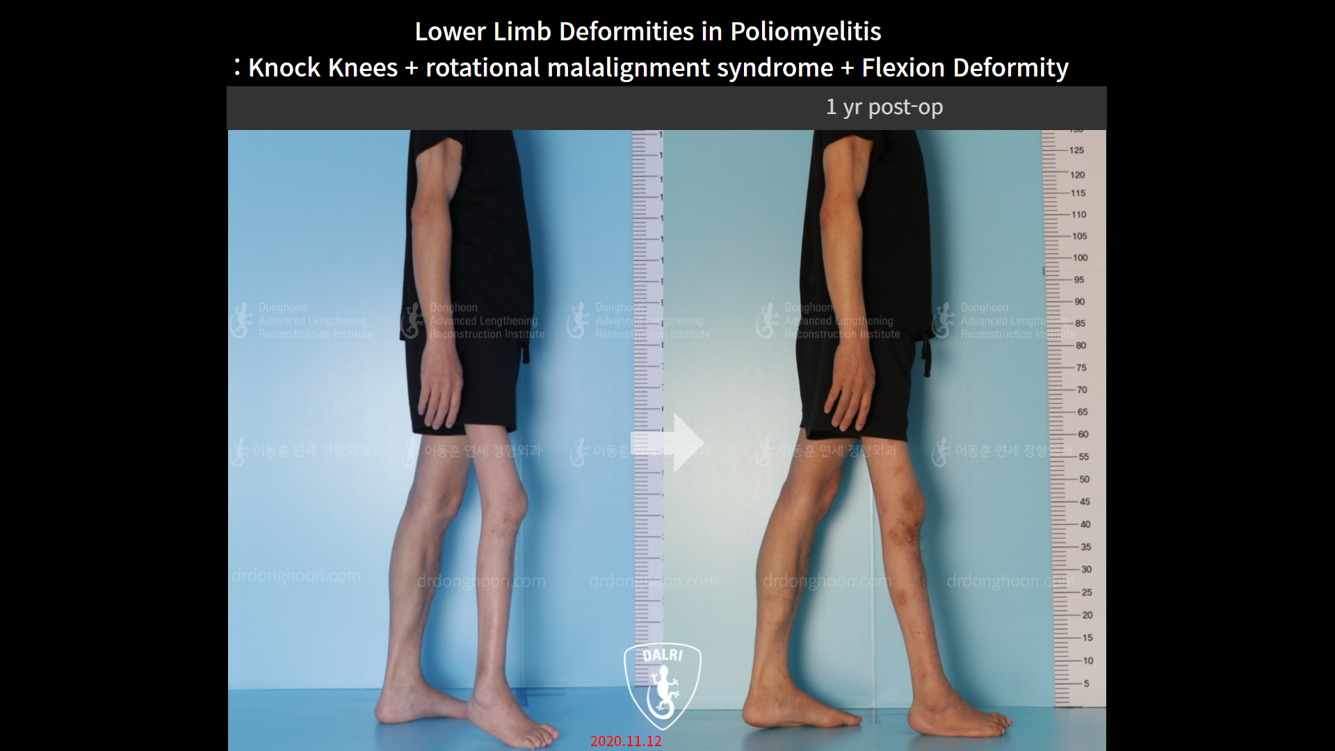 Before and after complex deformity, case 9154937, image 4, Dr. Donghoon institute (DALRI)