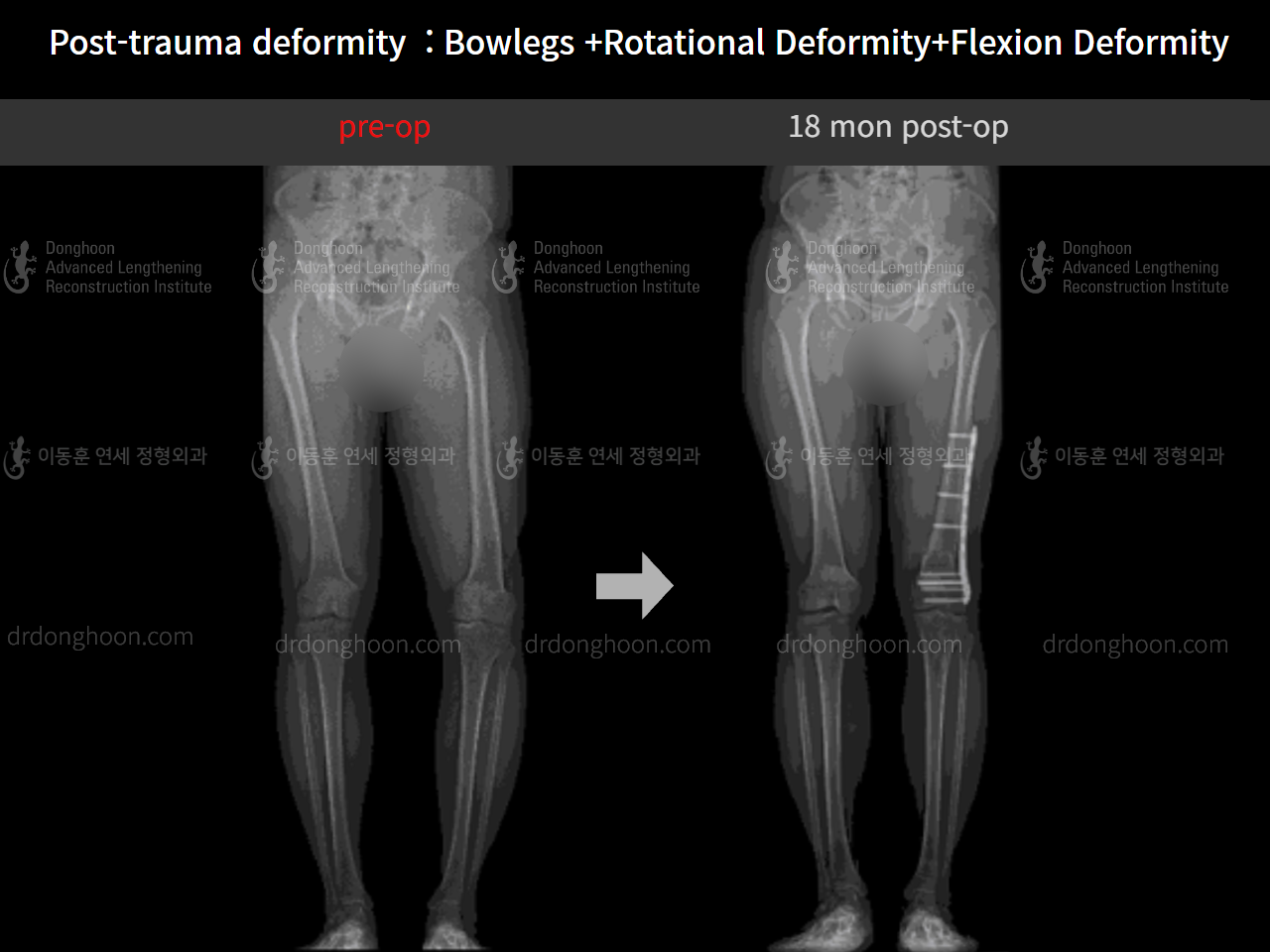 Before and after complex deformity, case 8725192, image 5, Dr. Donghoon institute (DALRI)