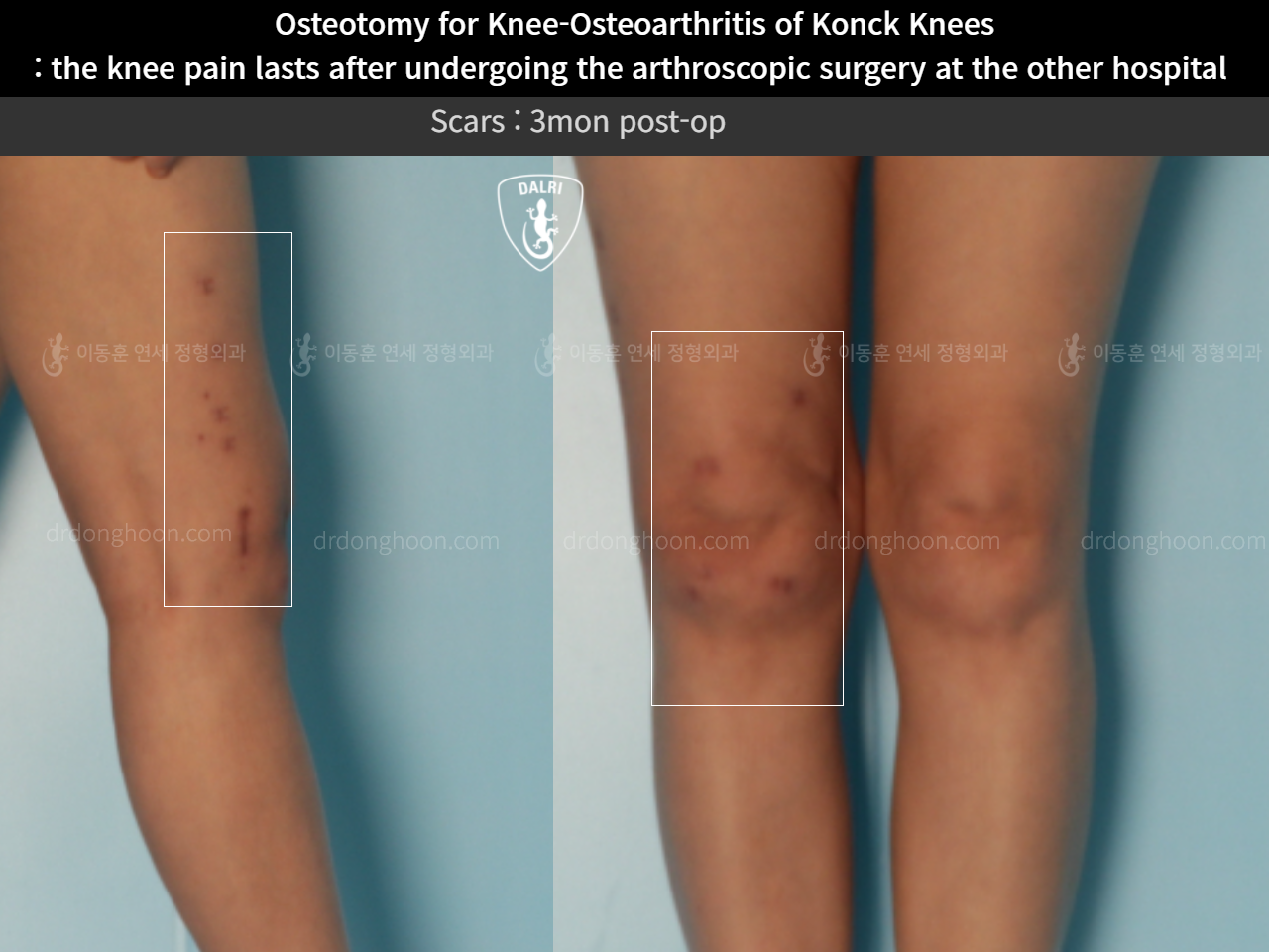 Before and after reoperation after deformity correction, case 10664605, image 5, Dr. Donghoon institute (DALRI)