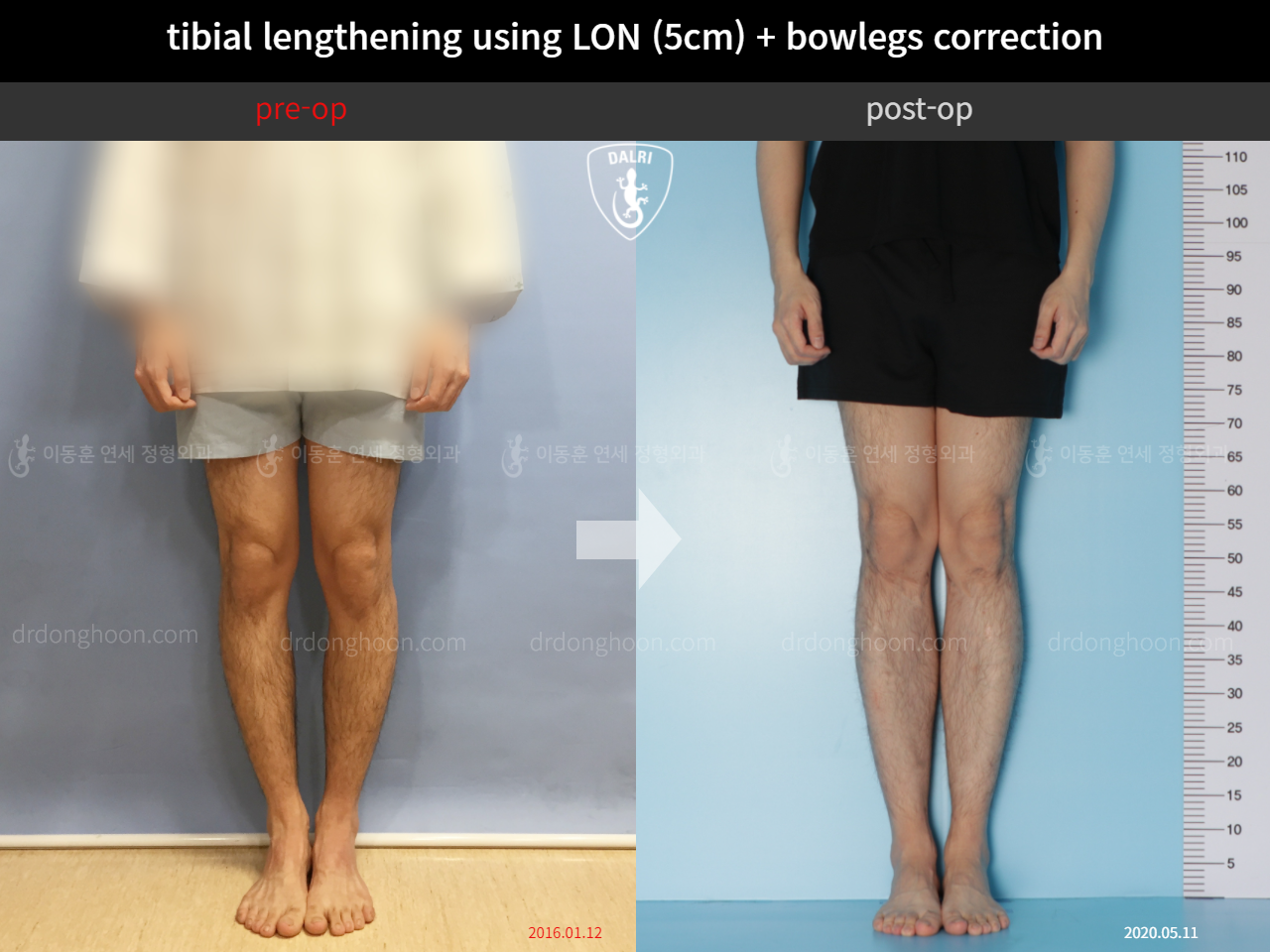 Before and after cll + deformity correction, case 4323130, image 5, Dr. Donghoon institute (DALRI)