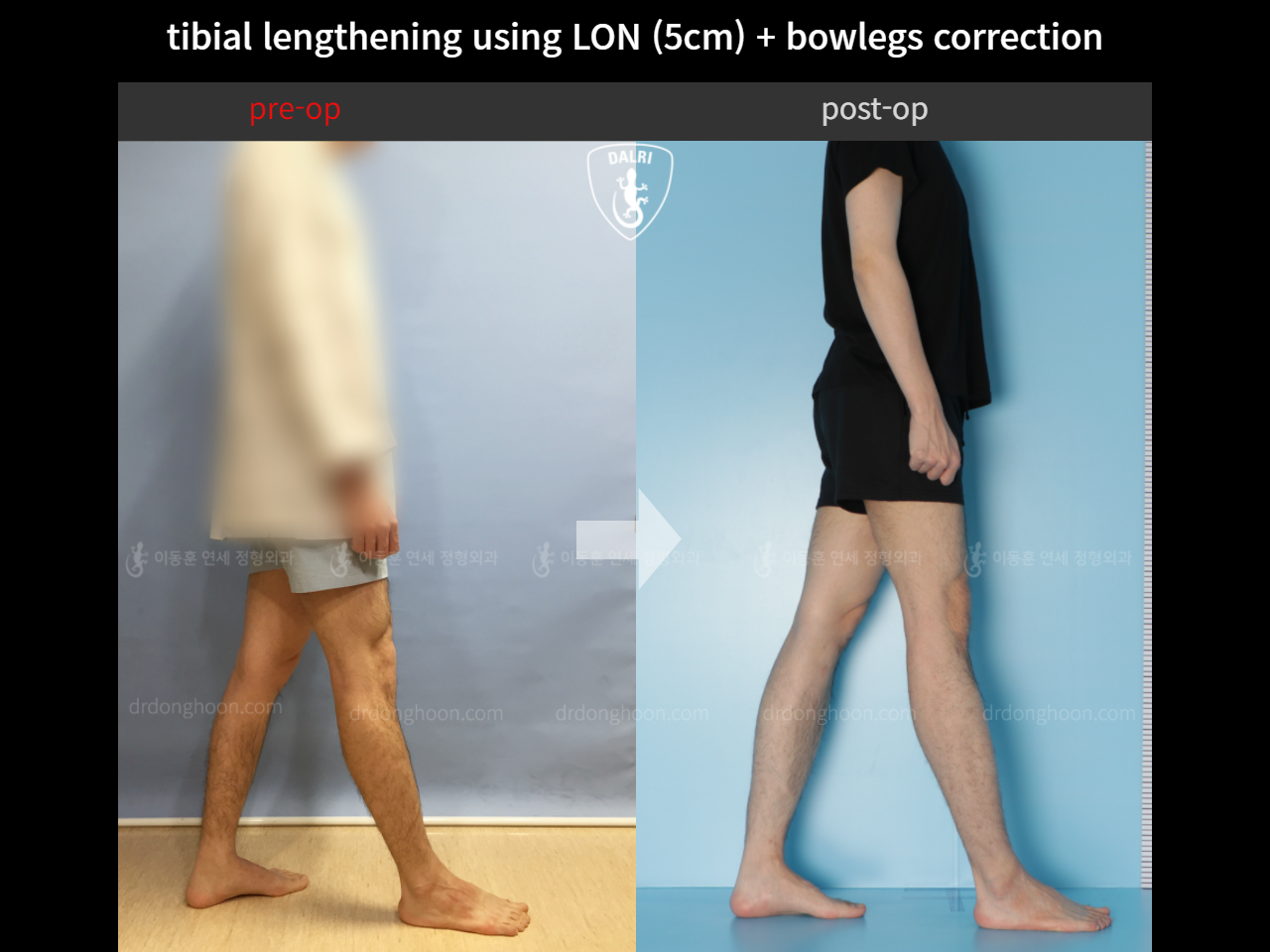 Before and after cll + deformity correction, case 4323130, image 3, Dr. Donghoon institute (DALRI)