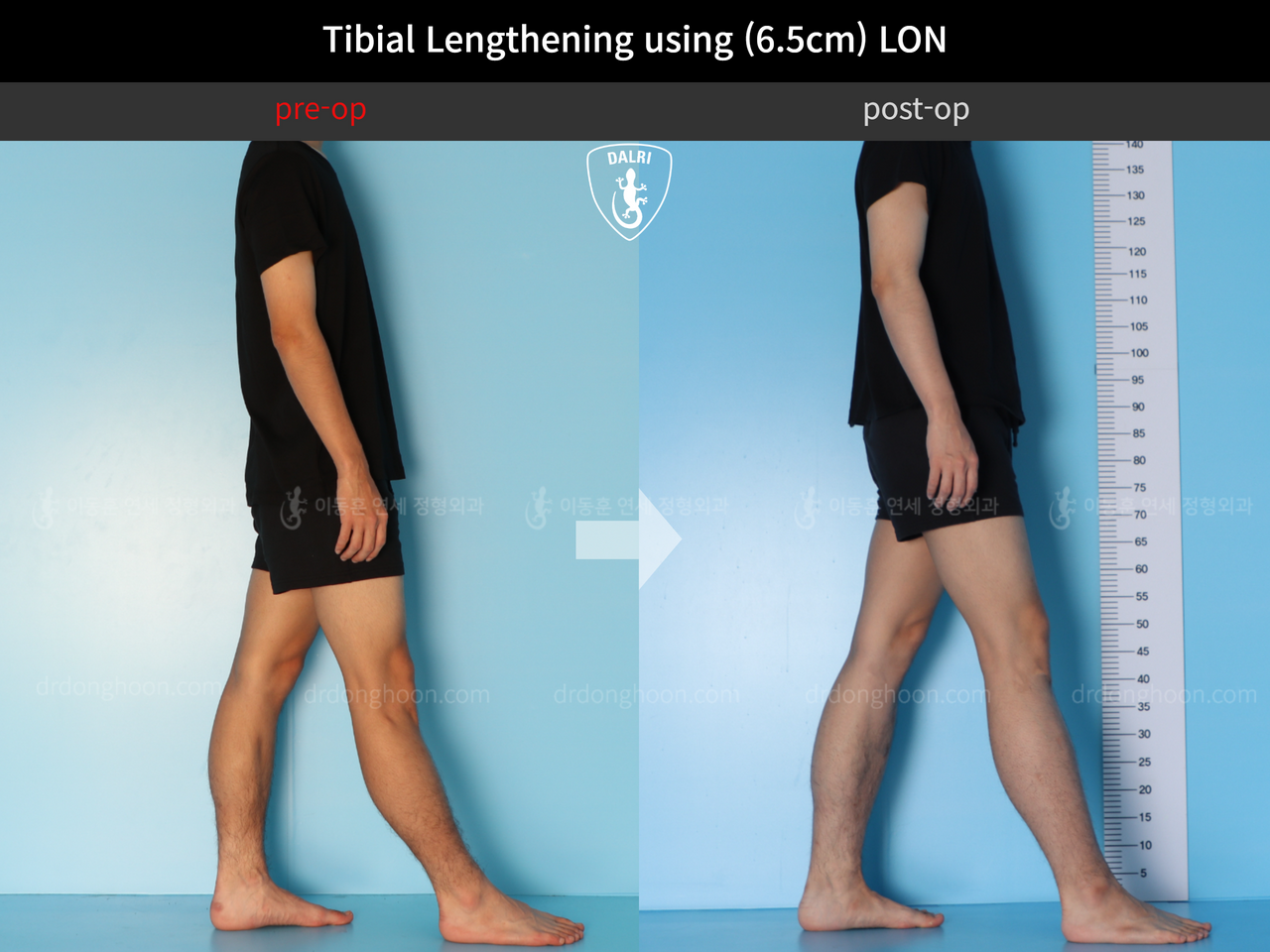 Before and after cll lon, case 12242145, image 3, Dr. Donghoon institute (DALRI)
