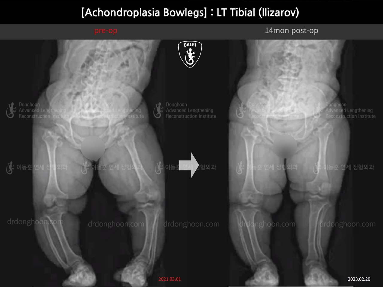 Before and after congenital condition, case 14296141, image 7, Dr. Donghoon institute (DALRI)