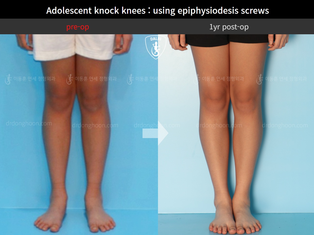 Before and after paediatric & adolescent knock knees, case 4310931, image 3, Dr. Donghoon institute (DALRI)