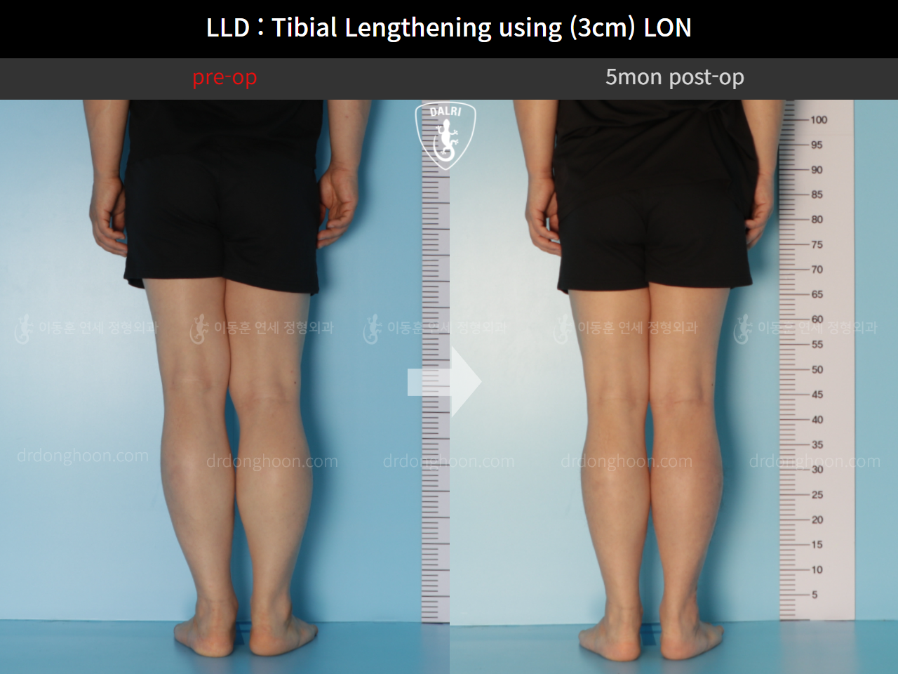 Before and after adult lld, case 11139768, image 5, Dr. Donghoon institute (DALRI)