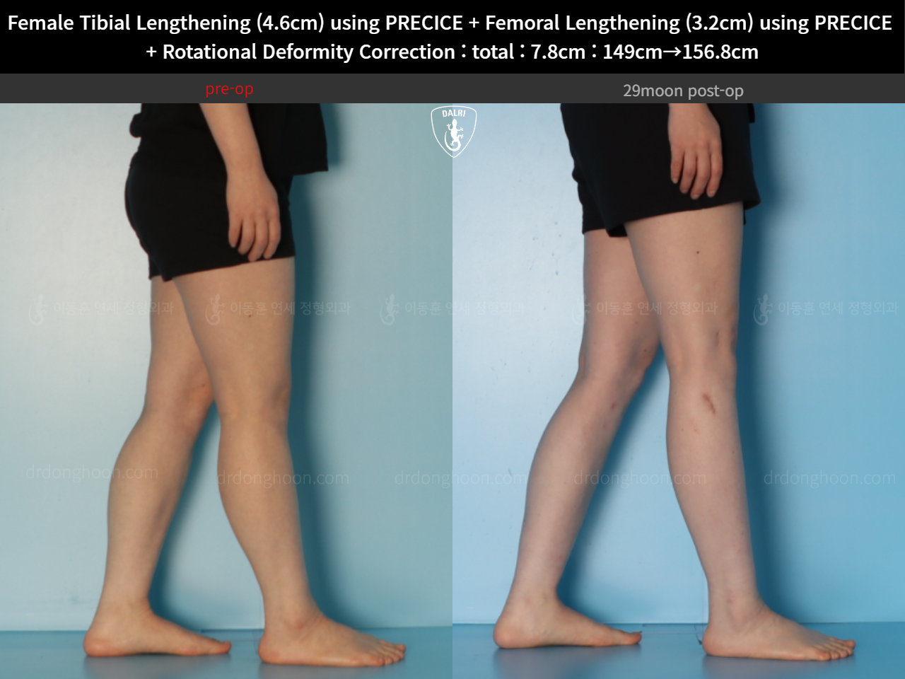 Before and after cll precice, case 123686647, image 12, Dr. Donghoon institute (DALRI)
